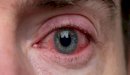 صورة مقال ما هو سبب احمرار العين