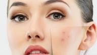 خلطة لإزالة آثار الحبوب في أسبوع صورة مقال خلطة لإزالة آثار الحبوب في أسبوع