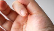 أمراض نقص الفيتامينات أمراض نقص الفيتامينات