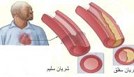ما هي أمراض القلب صورة مقال ما هي أمراض القلب