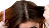 كيف أزيل القشرة من الشعر صورة مقال كيف أزيل القشرة من الشعر