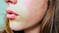 كيف أزيل الحبوب من وجهي في يوم صورة مقال كيف أزيل الحبوب من وجهي في يوم
