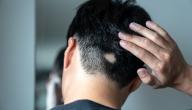 أنواع الثعلبة صورة مقال أنواع الثعلبة