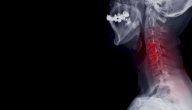 علاج الانزلاق الغضروفي في الرقبة صورة مقال علاج الانزلاق الغضروفي في الرقبة