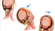 ما هو ارتجاج المخ صورة مقال ما هو ارتجاج المخ