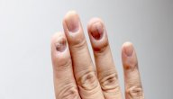ما هي الأمراض التي تصيب الأظافر ما هي الأمراض التي تصيب الأظافر