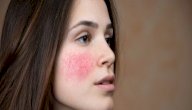 كيف تعالج احمرار الوجه صورة مقال كيف تعالج احمرار الوجه