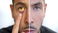 أسباب اصفرار الوجه أسباب اصفرار الوجه