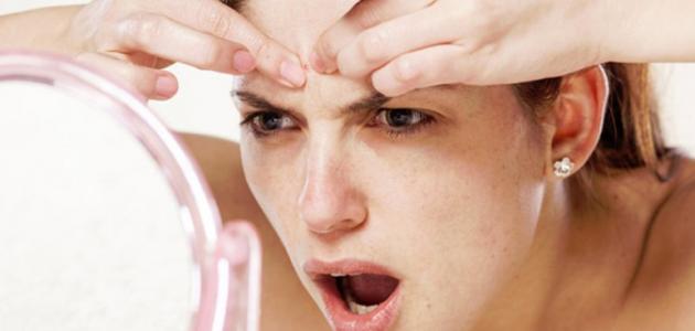 كيف أزيل آثار حبوب الشباب كيف أزيل آثار حبوب الشباب
