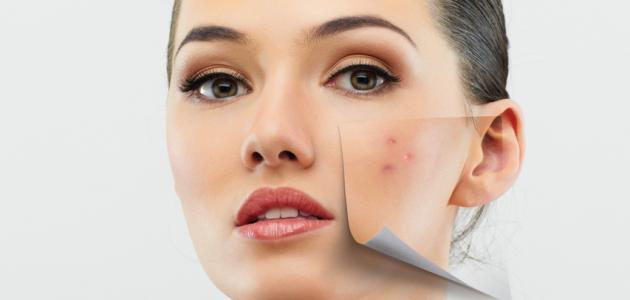 طرق لعلاج حب الشباب وآثاره طرق لعلاج حب الشباب وآثاره