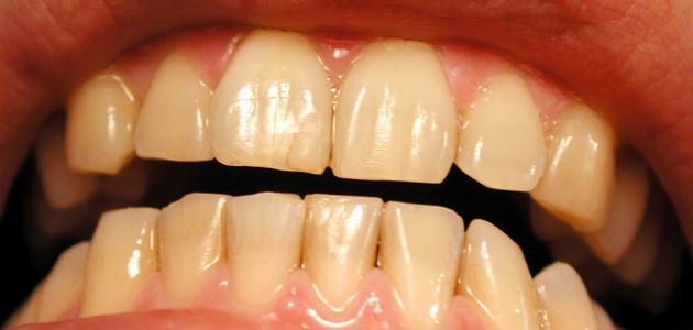 ما أسباب اصفرار الأسنان ما أسباب اصفرار الأسنان