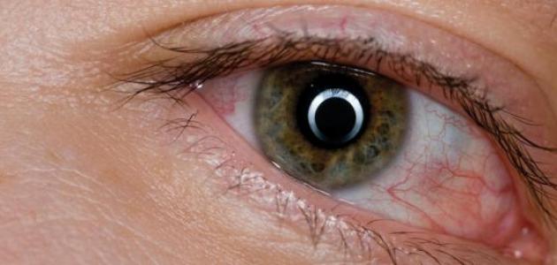 ما علاج تورم العين