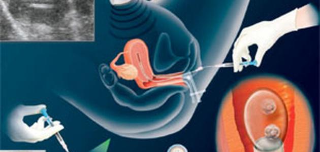 كيف تتم عملية طفل الأنابيب موضوع