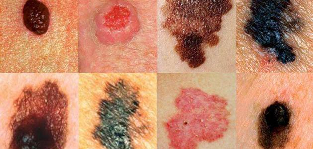 أعراض سرطان الجلد